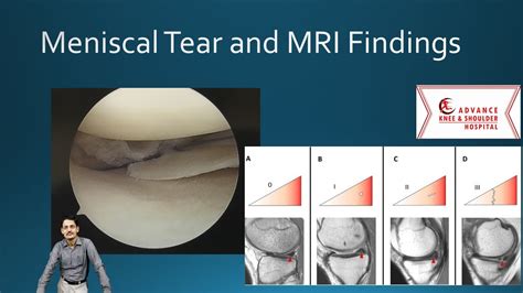 test for meniscus tear youtube|diagnose meniscus tear without mri.